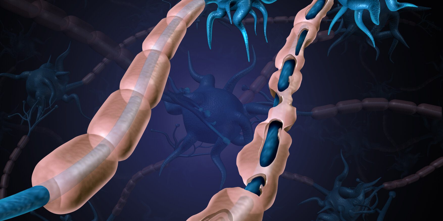 Multiple Sclerosis Damaged Myelin