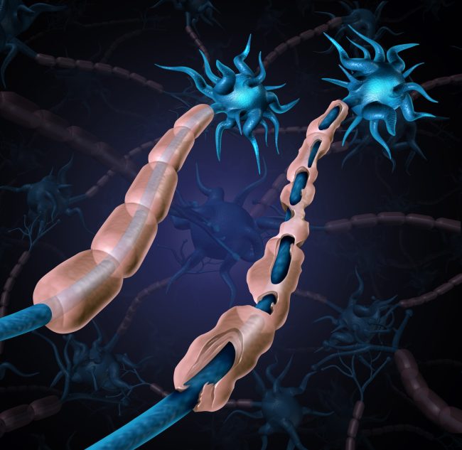Multiple Sclerosis Damaged Myelin
